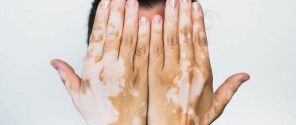 vitiligo